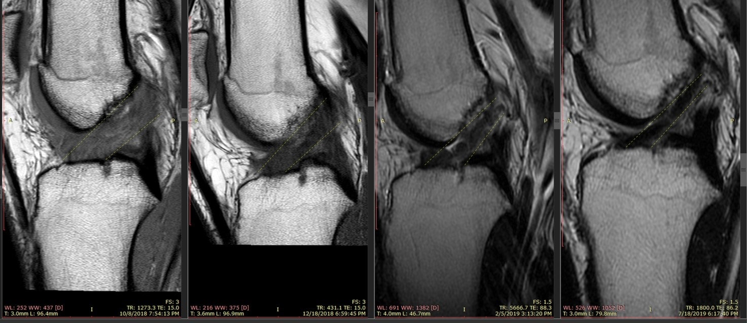 ACL ligament treatment