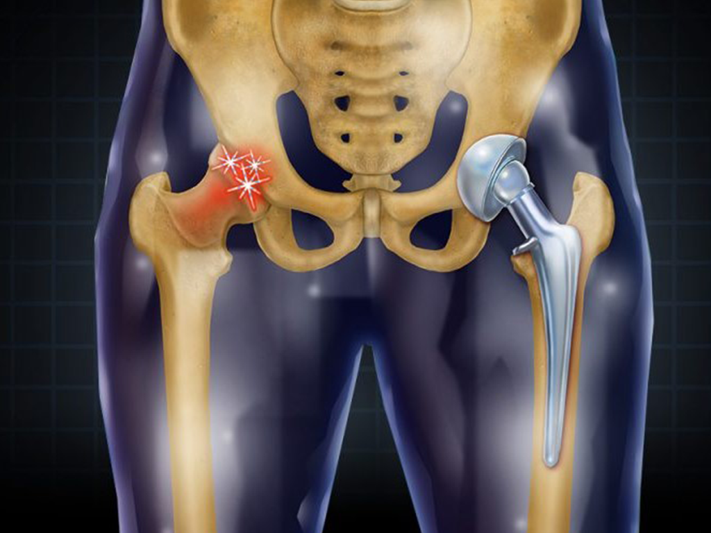 Hip Replacement