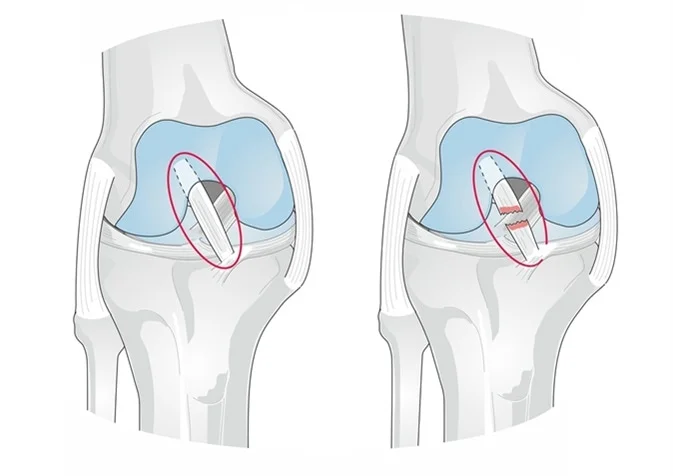 acl ligament bhopal