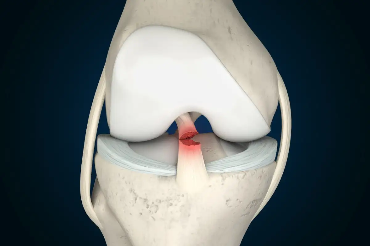 ACL ligament treatment