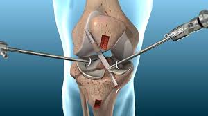 ACL Surgeon