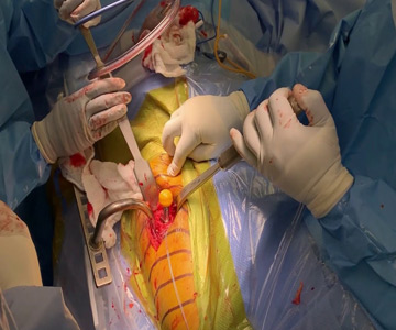  Robotic Hip Replacement