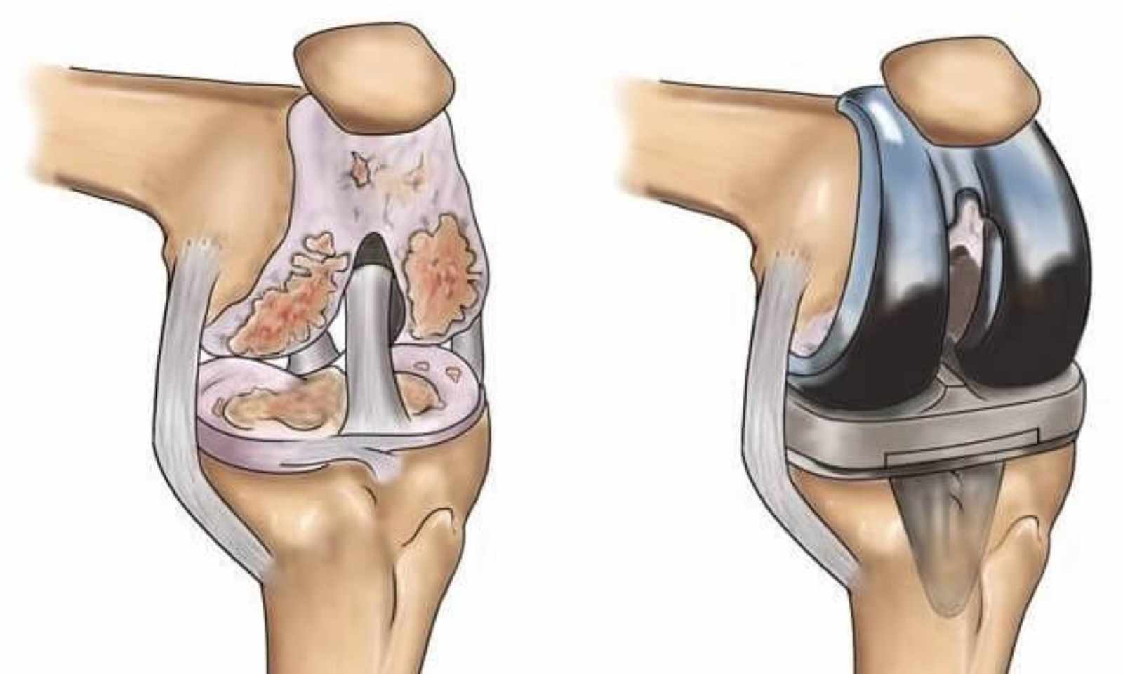 Robotic Joint Replacement