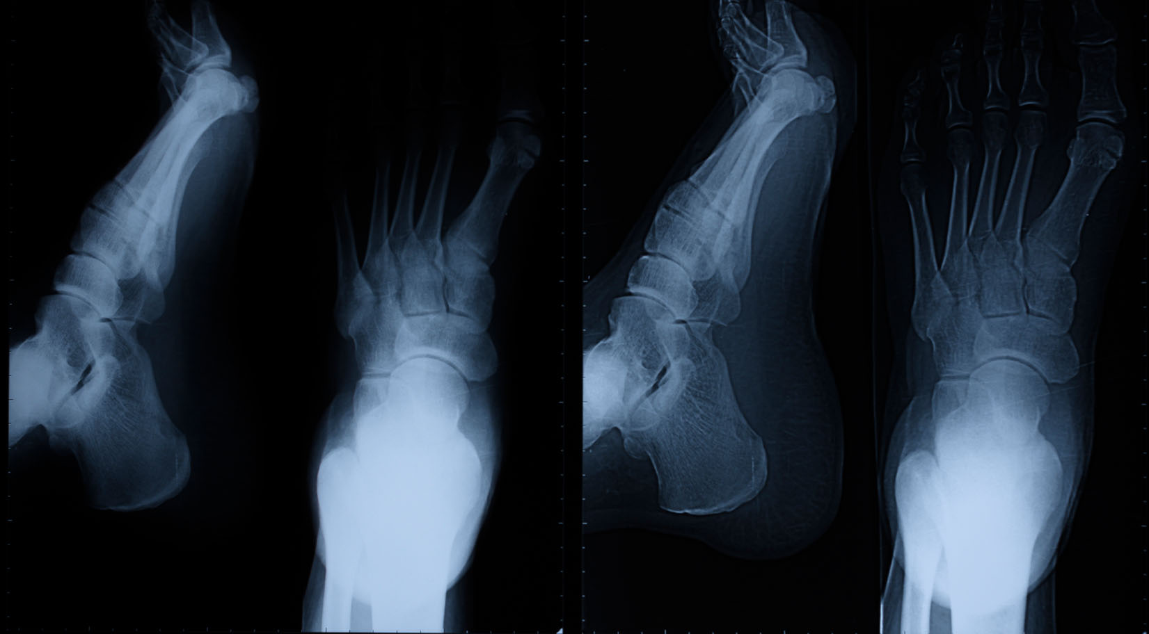 Fracture Treatment