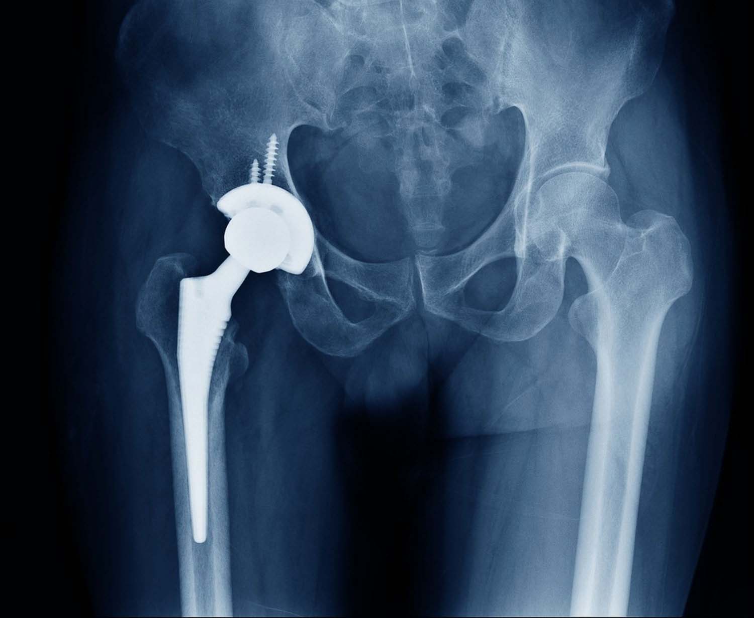 Hip Replacement