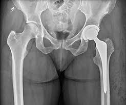 Hip Replacement