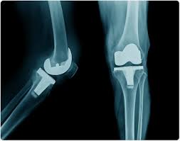 knee Replacement