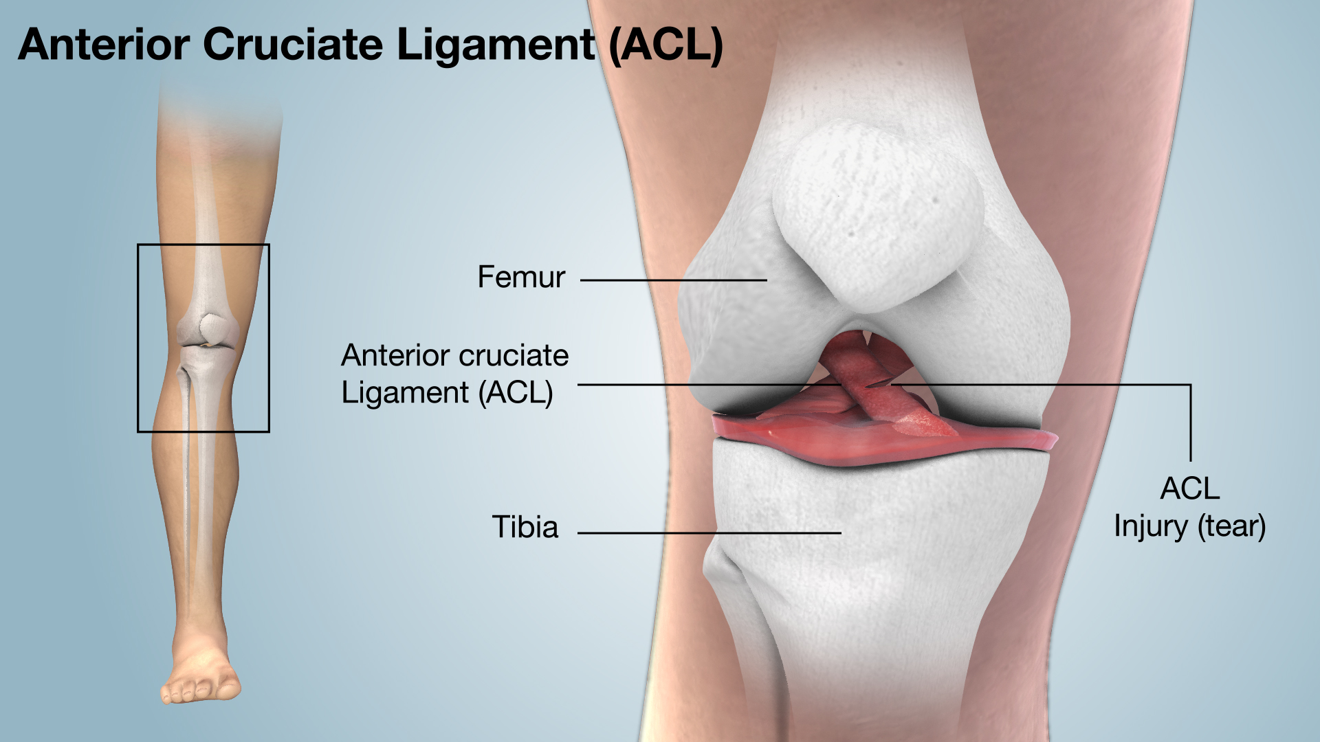 ACL ligament treatment